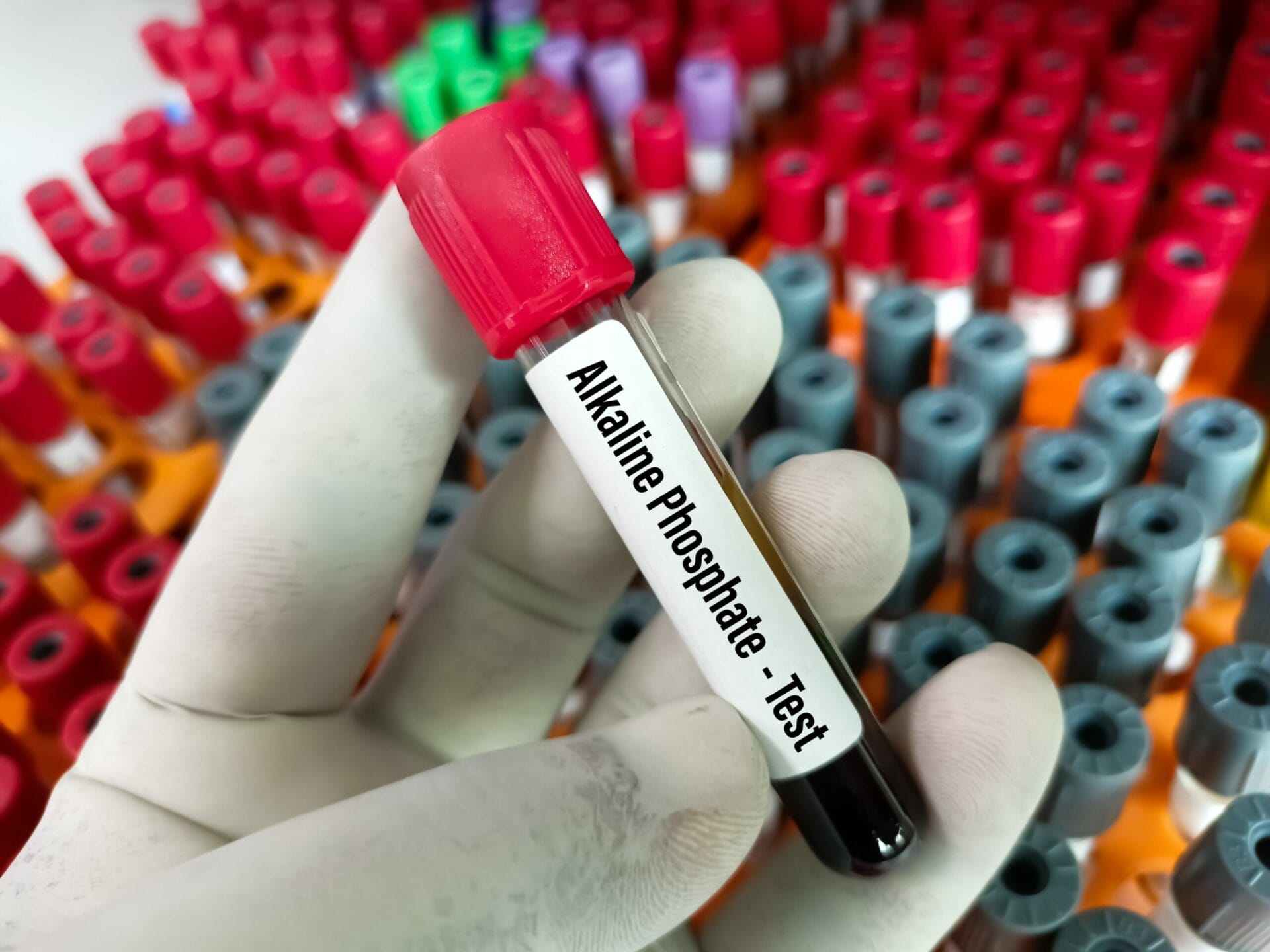 Bone Specific Alkaline Phosphatase Test in Pune