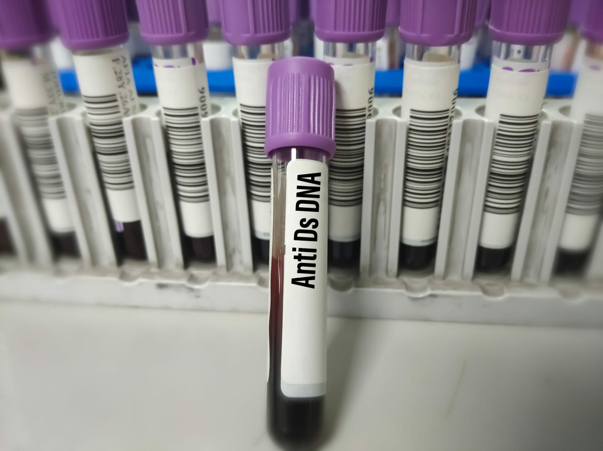 Anti-Ds DNA Antibody Test In Pune