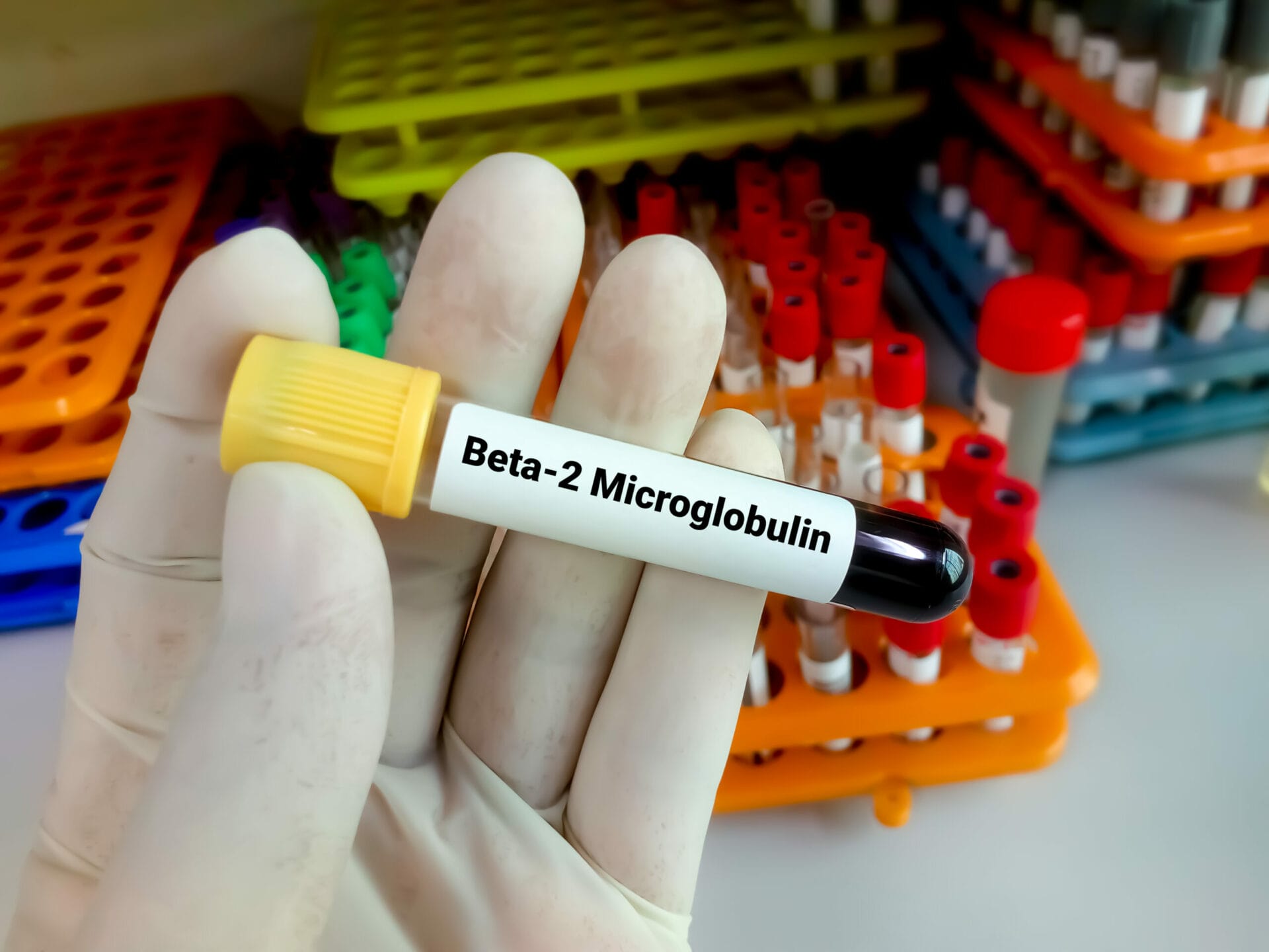 Beta­2 Microglobulin Serum Test in Gurgaon
