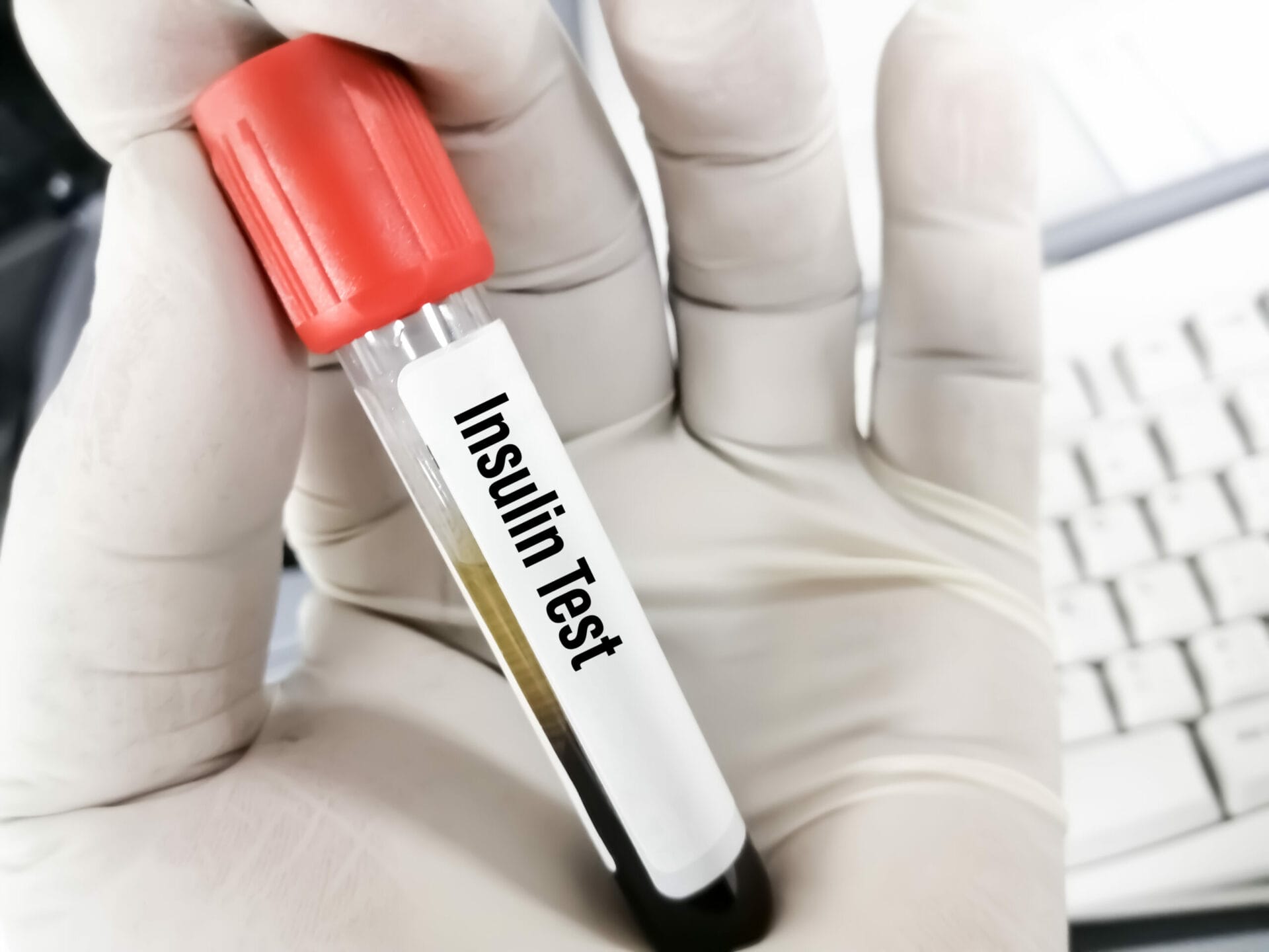 Insulin Random Test In Bangalore