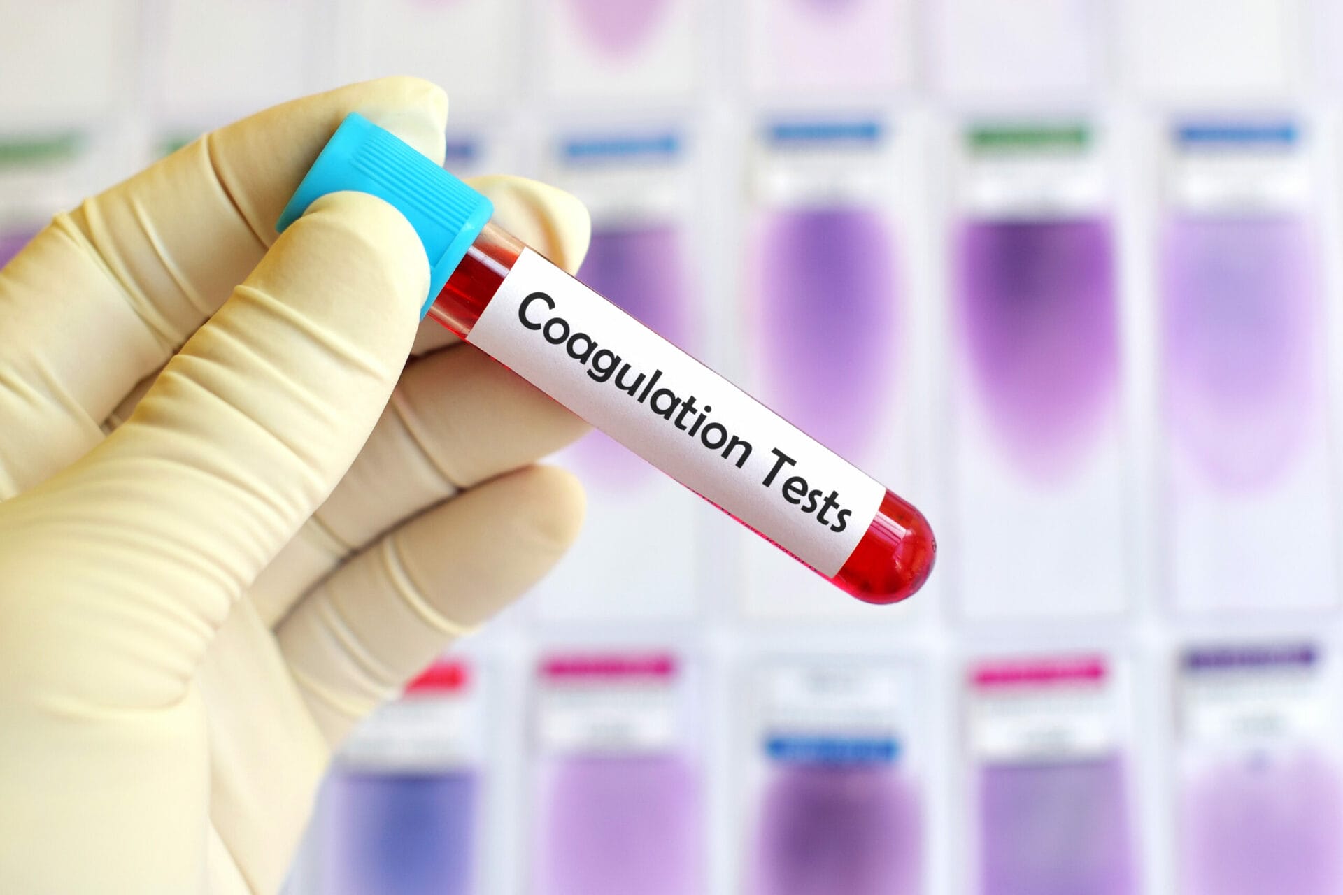Coagulation Profile Test In Faridabad