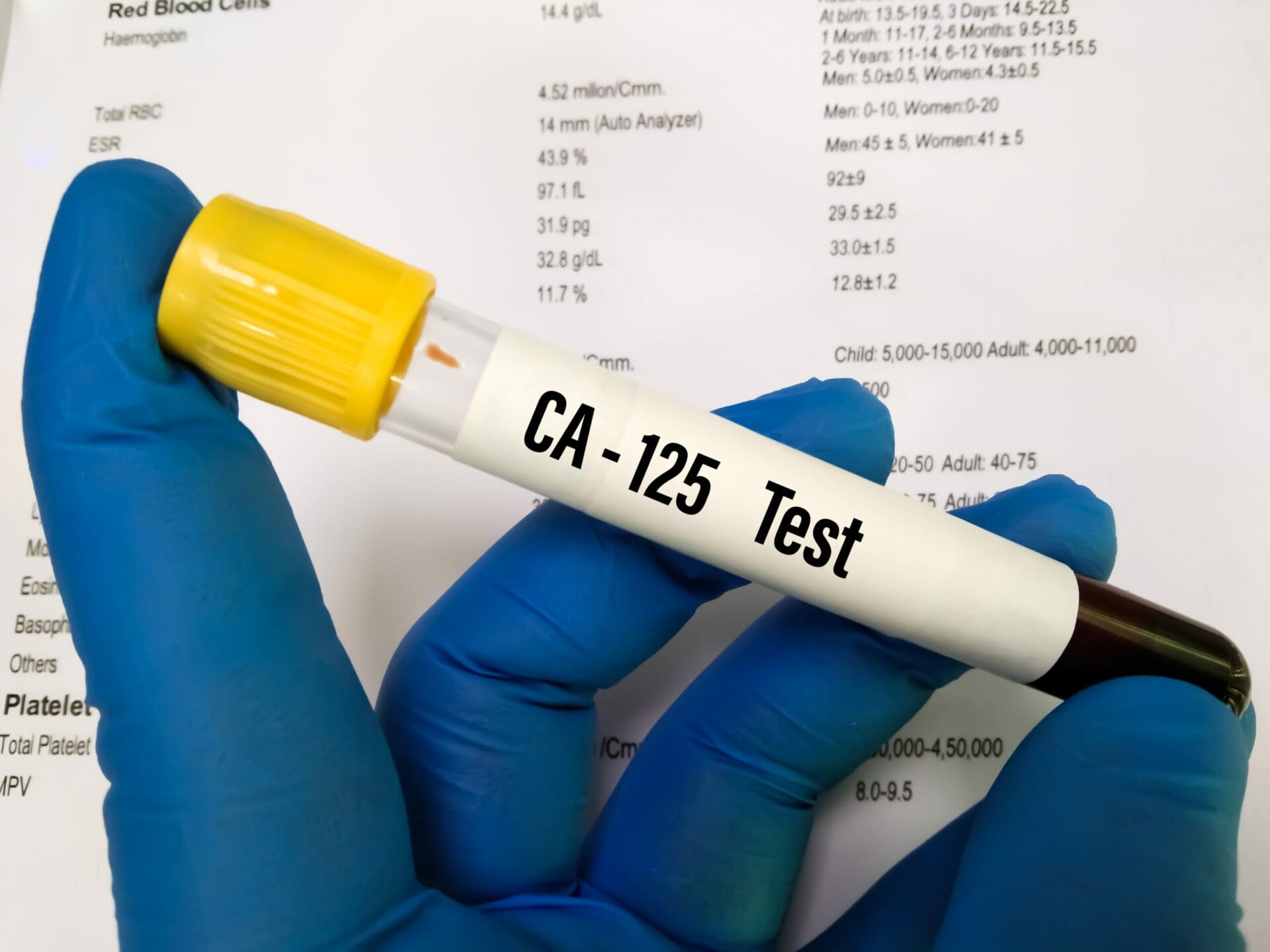 CA125 - Ovarian Cancer marker Test In Gurgaon