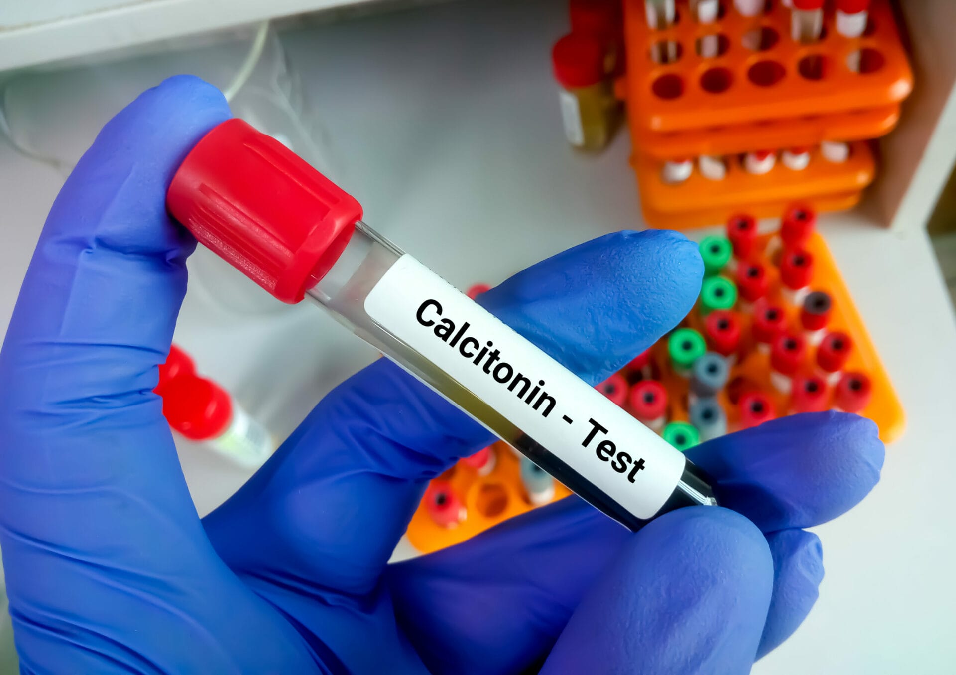 Calcitonin Test In Delhi
