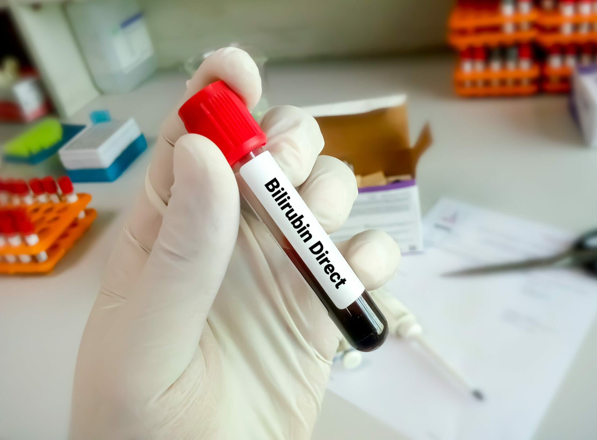 Direct Bilirubin Serum Test in Delhi
