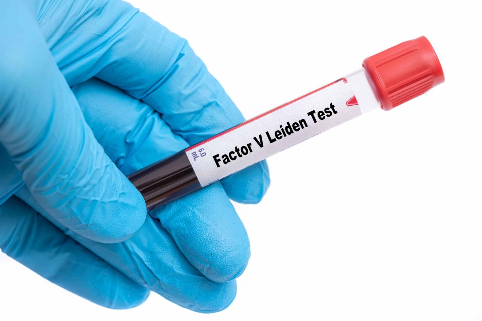 Factor V Leiden Mutation Test In Noida
