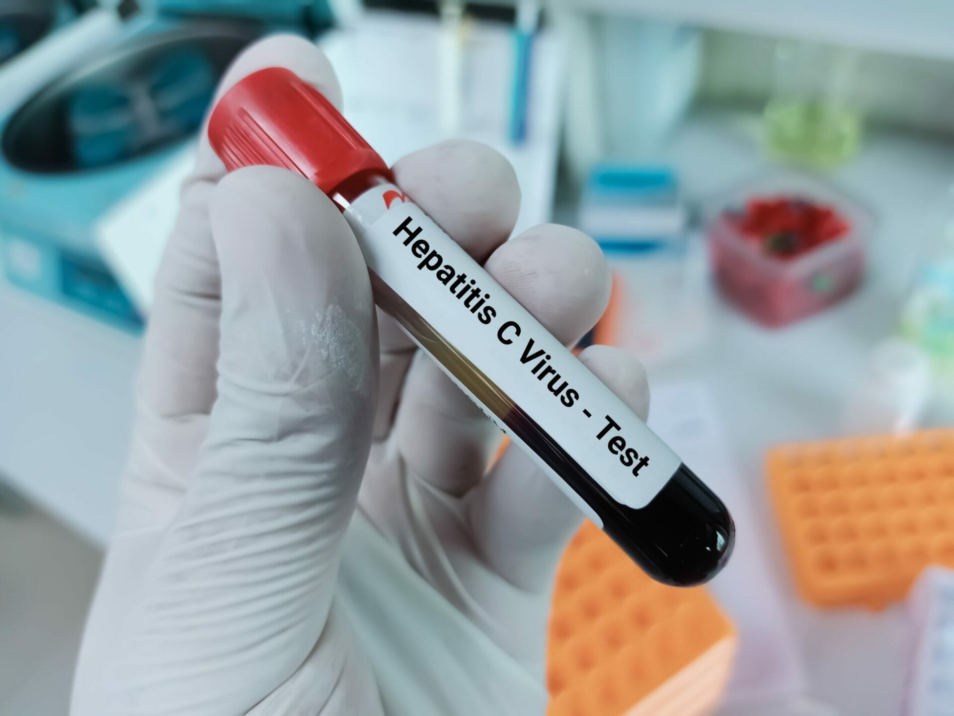 Elisa Anti-HCV Test In Ahmedabad