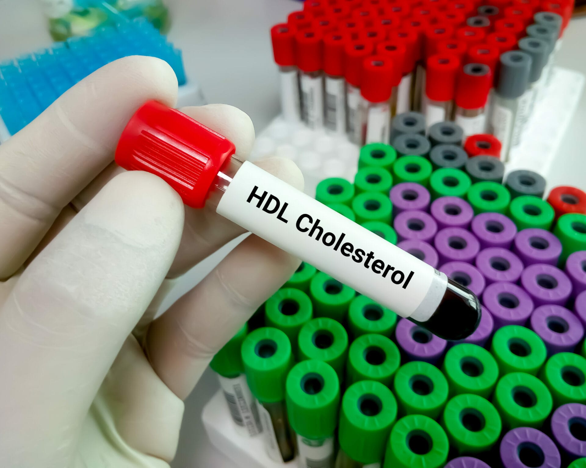 High-density Lipoprotein (HDL) Test in Delhi