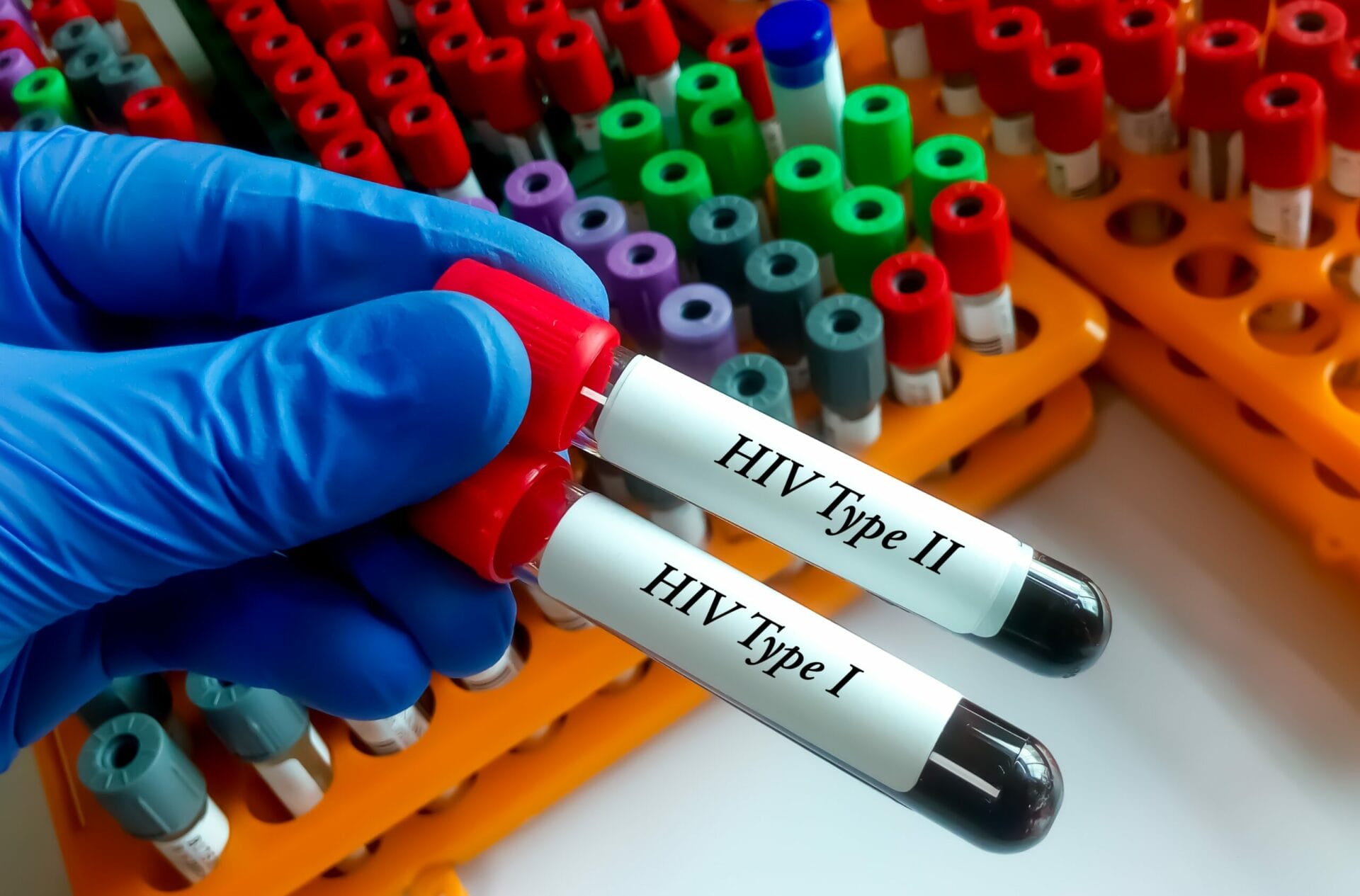 HIV 1 & 2 Antibody Test In Lucknow