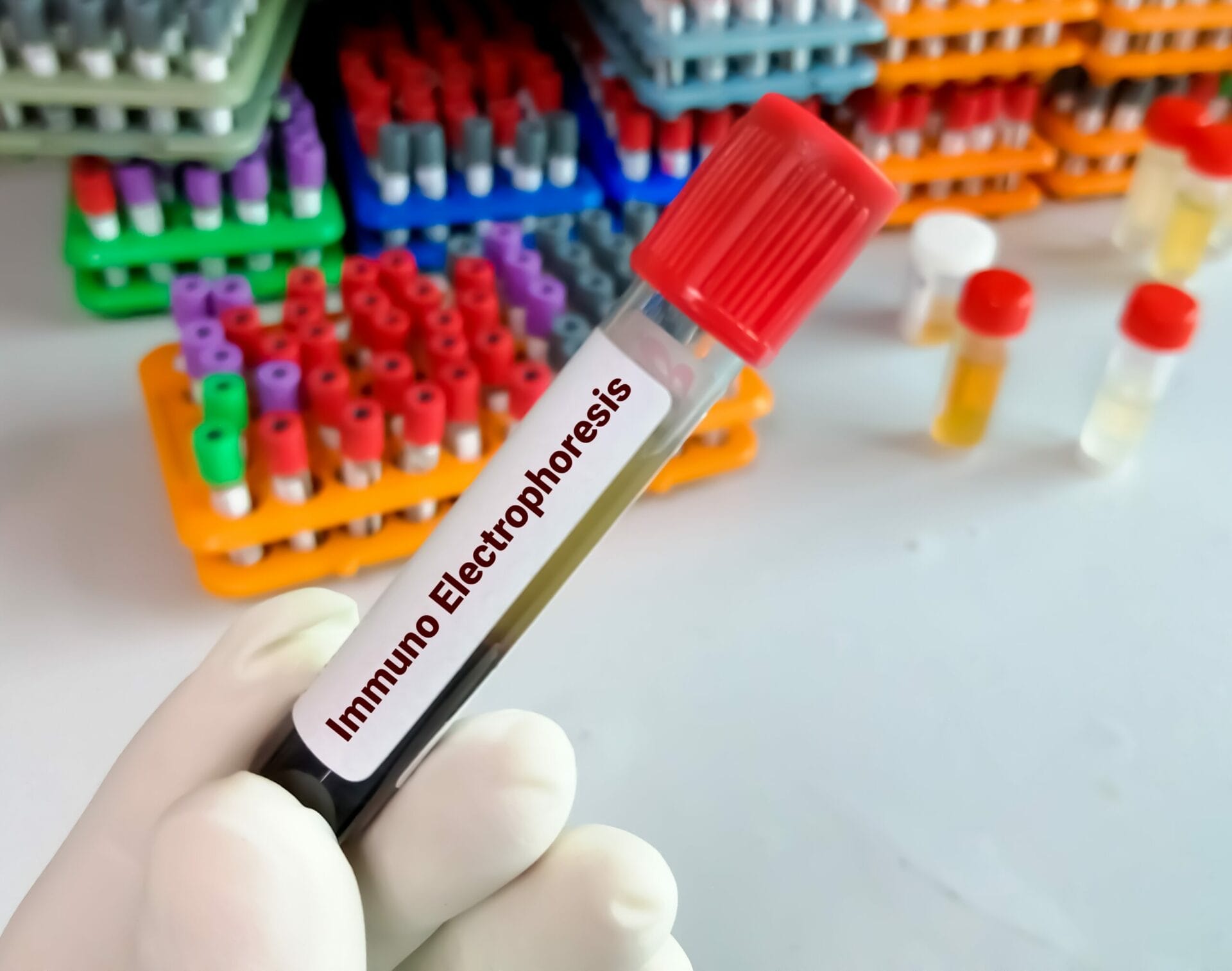 Immunofixation Electrophoresis Serum Test In Hyderabad