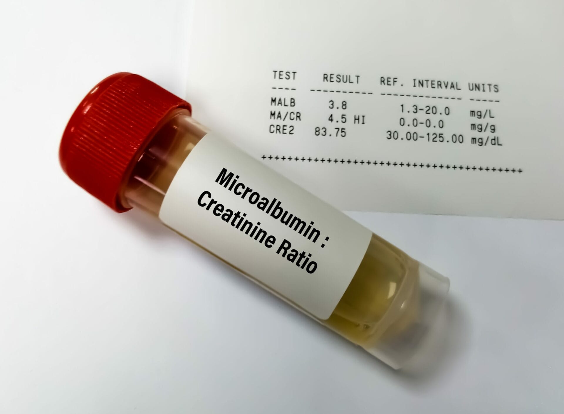 Microalbumin Creatinine Ratio Test In Lucknow