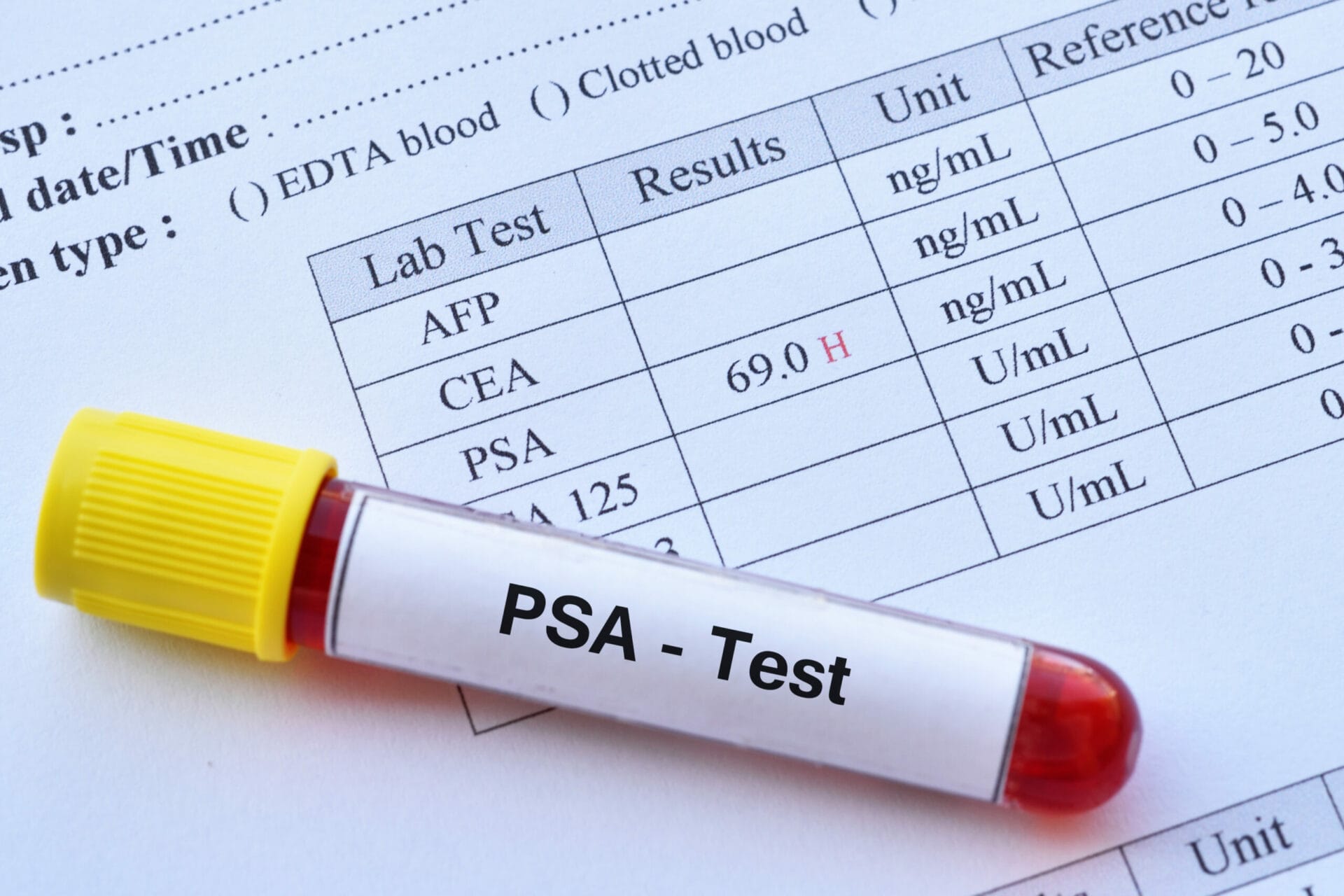 Prostate Specific Antigen - PSA Test In Chandigarh