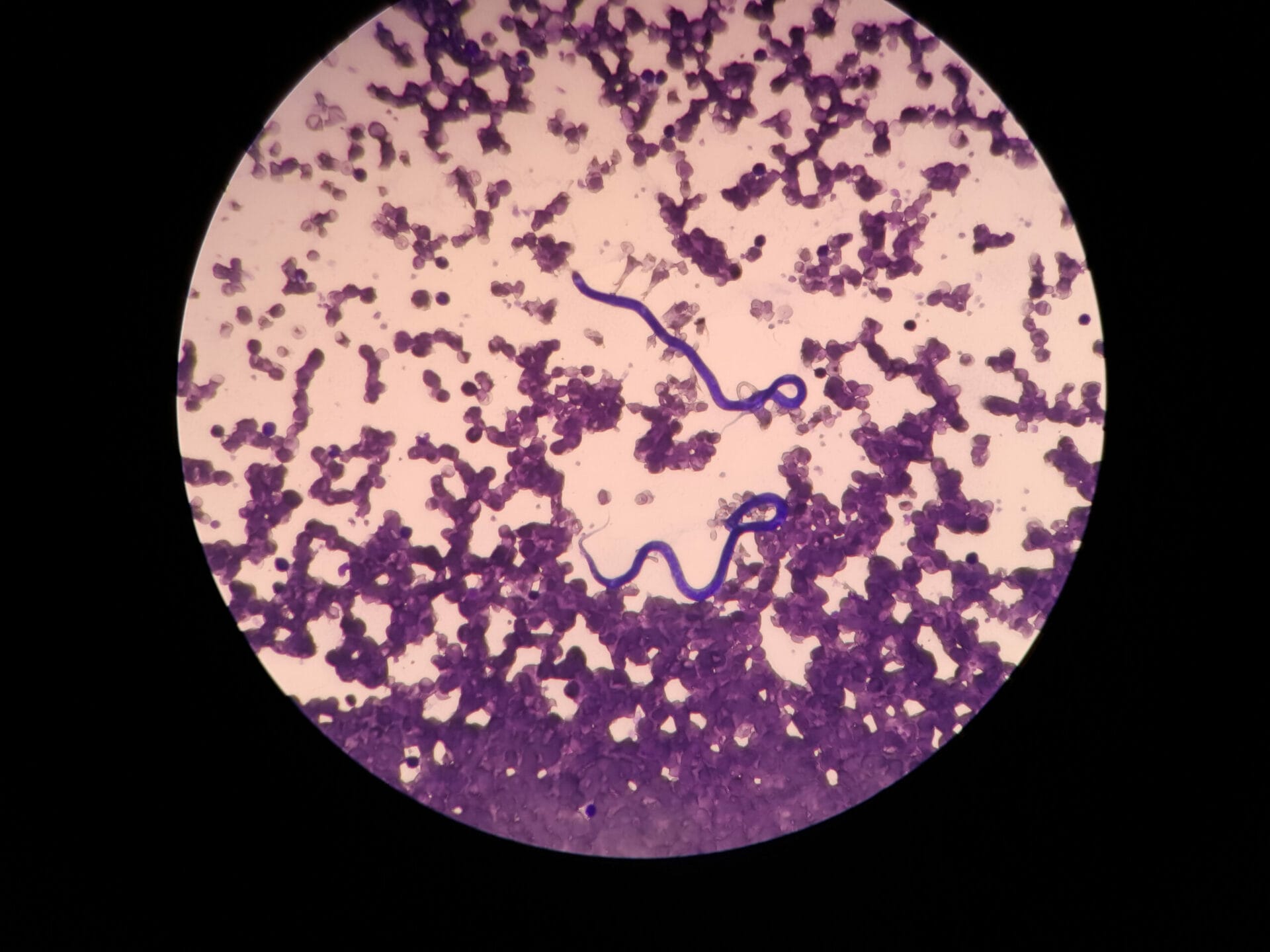 Microfilaria Detection Test In Chandigarh