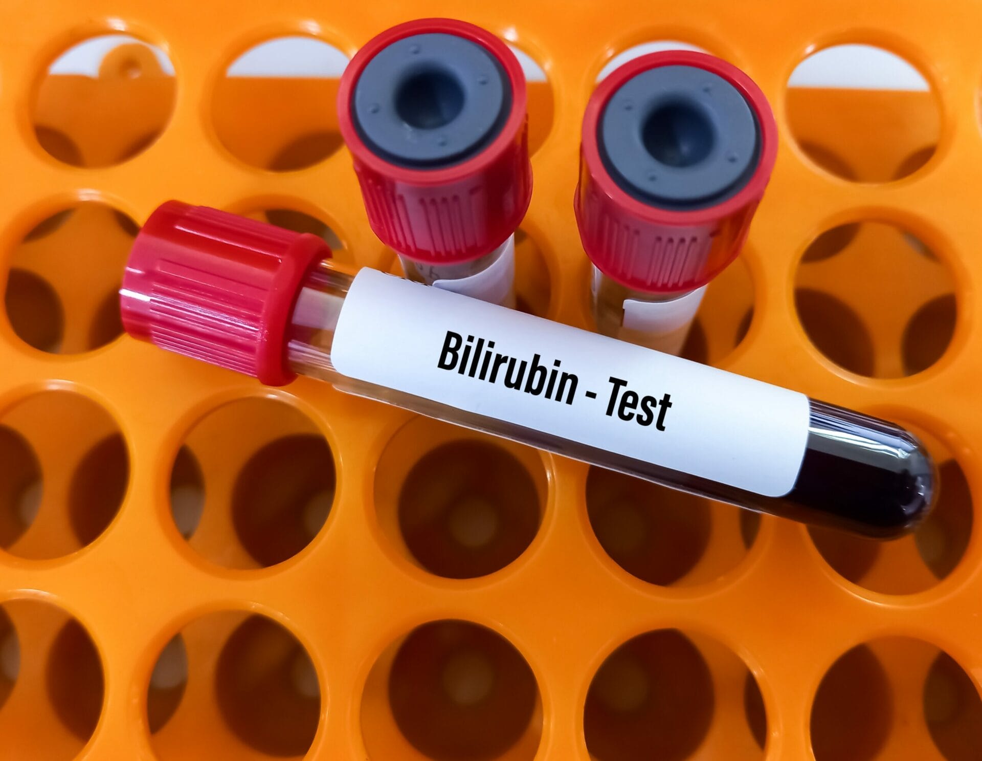 Total Bilirubin Serum Test in Delhi