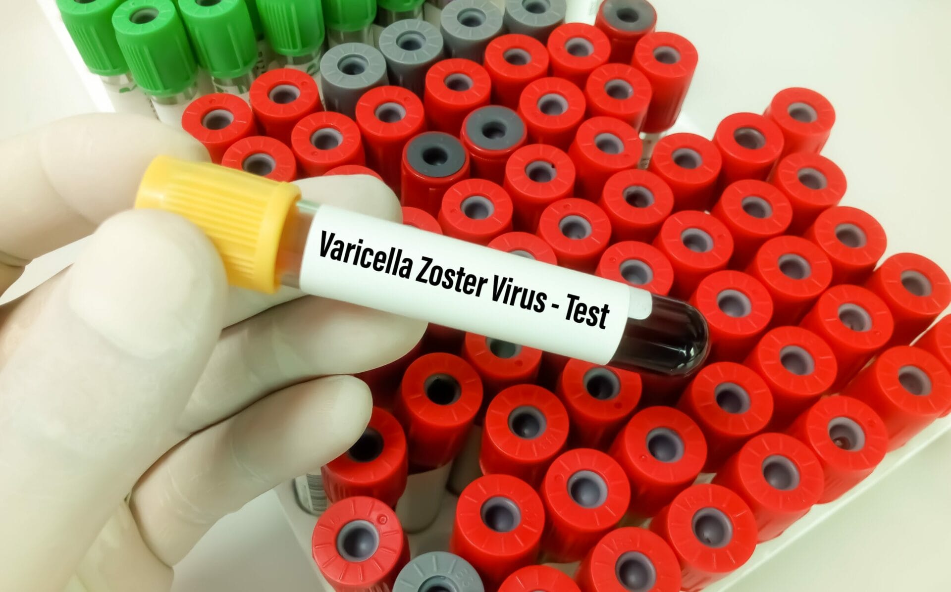 Varicella Zoster Virus IgM (Chickenpox) Test In Hyderabad