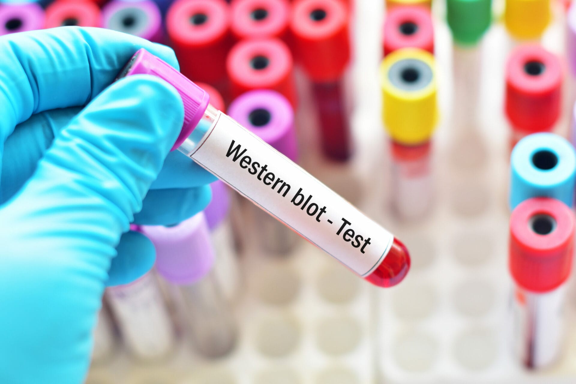 Western Blot for HIV Test In Delhi