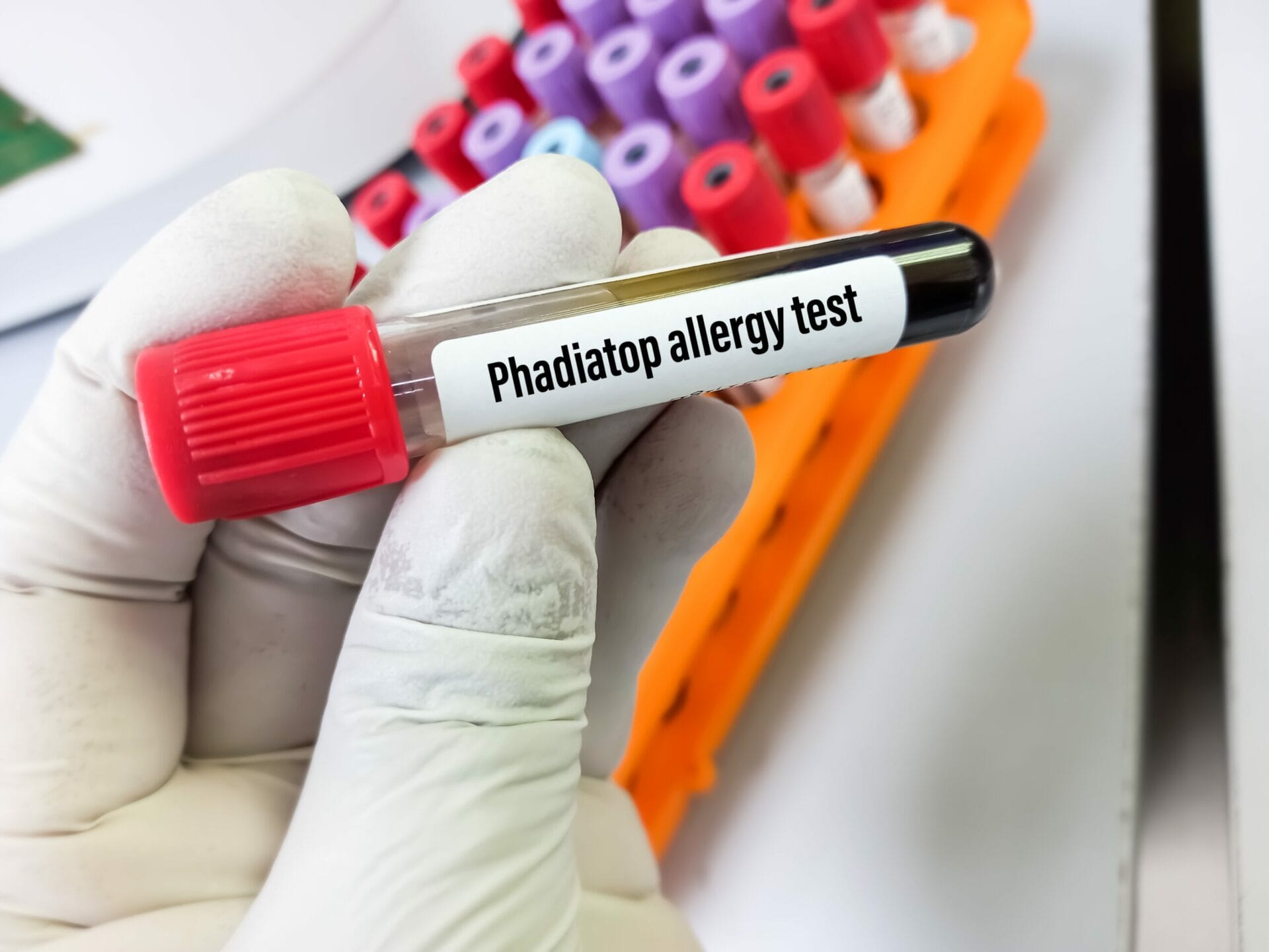 Phadiatop Allergy Test In Hyderabad