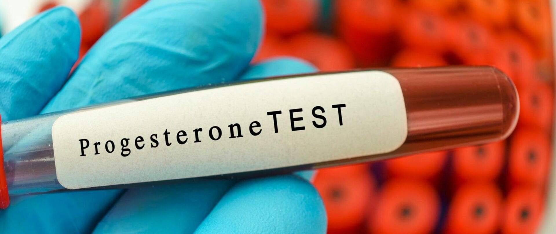 17 ­OH Progesterone Test In Lucknow