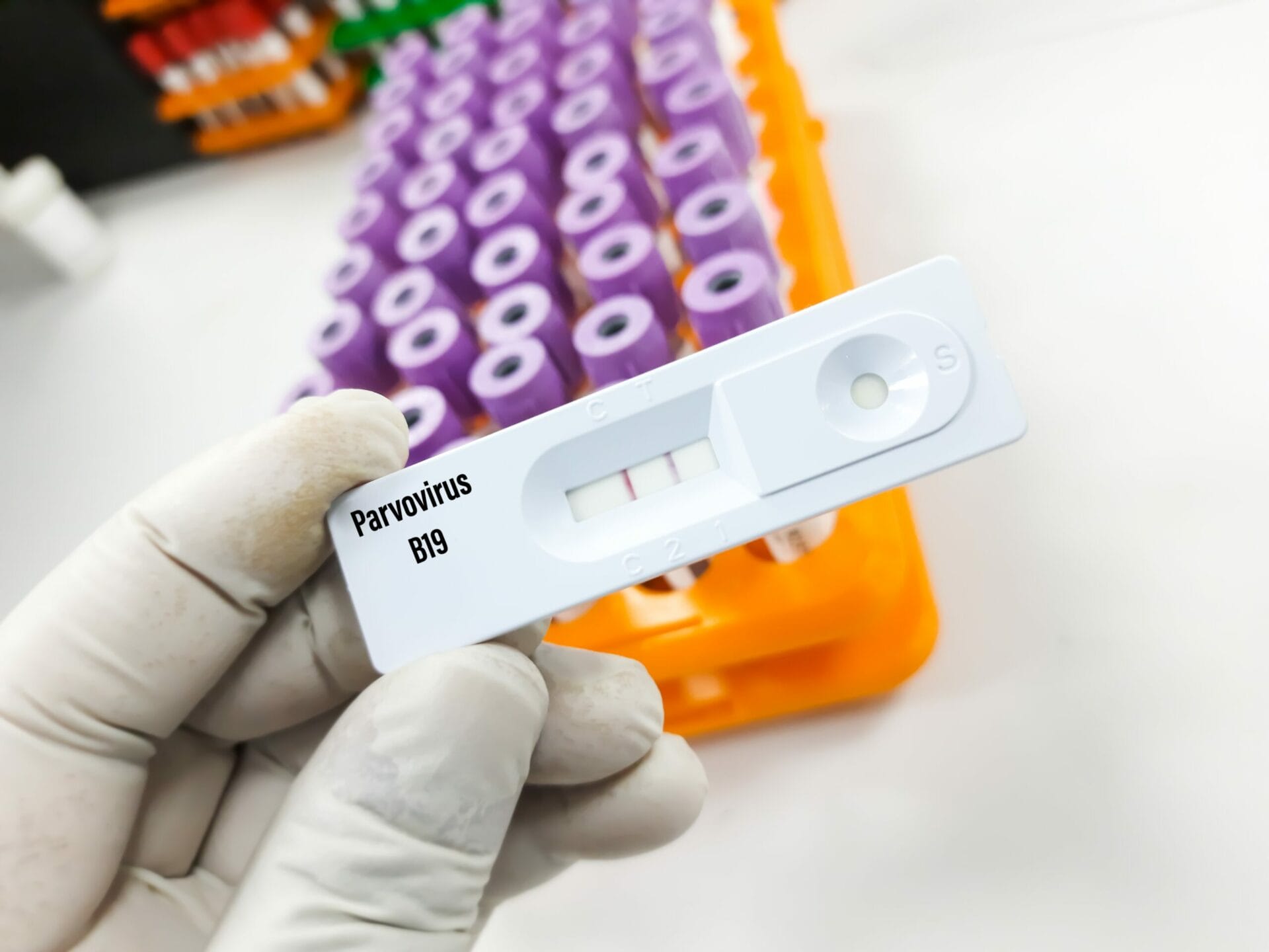 Parvovirus B19 IgM Test In Kolkata