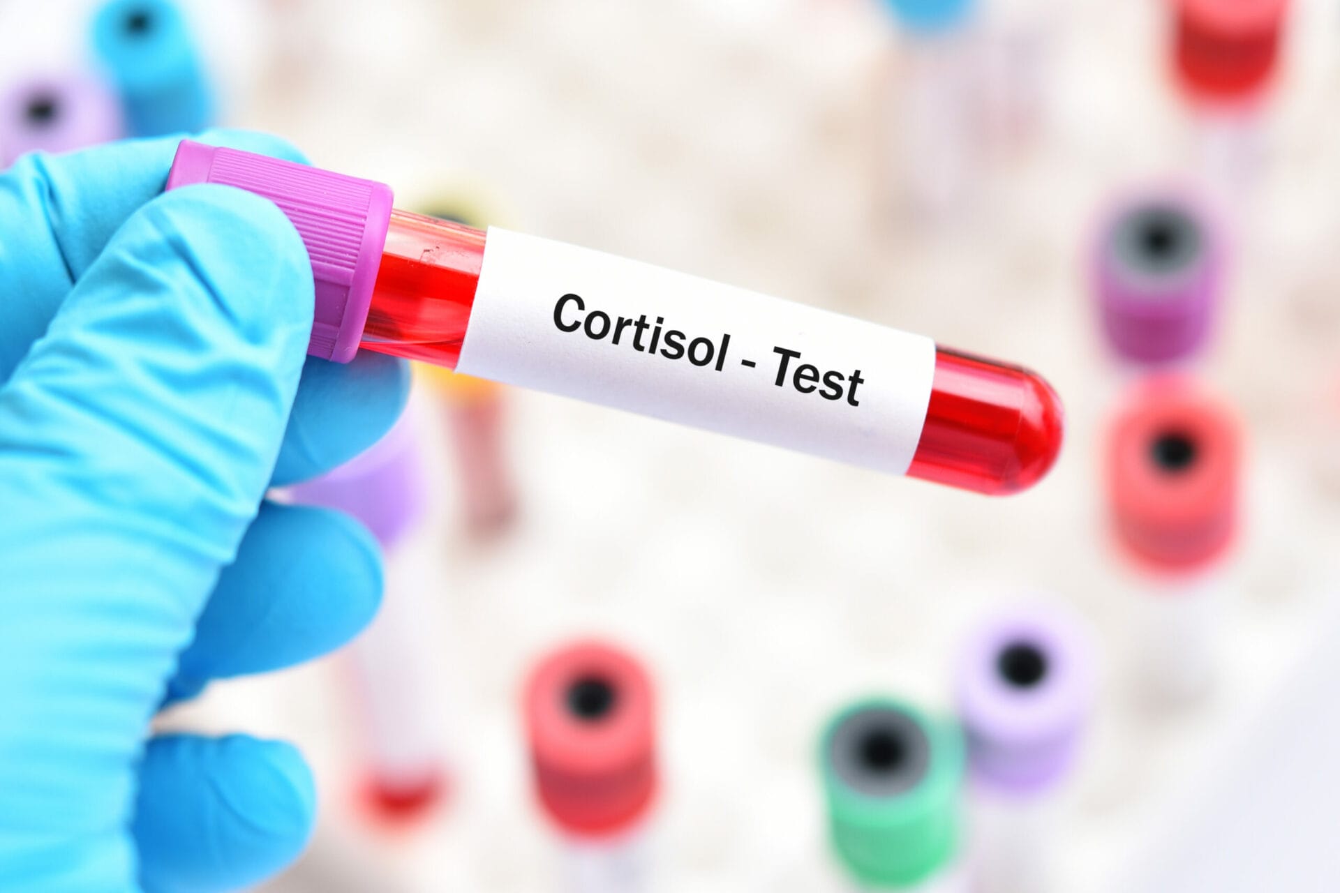 Cortisol Serum Test In Delhi